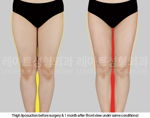 thigh_liposuction_02_07_250124