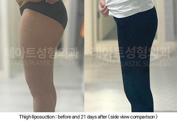 thigh_liposuction_02_07_250211