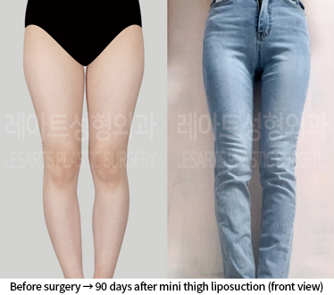 thigh_liposuction_02_08_240809
