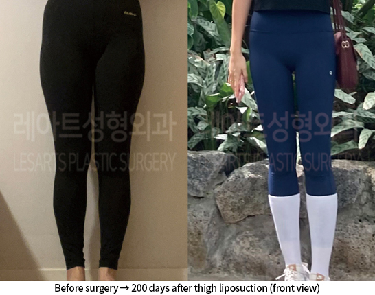 thigh_liposuction_02_08_240812