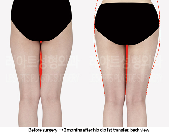 thigh_liposuction_02_08_240822