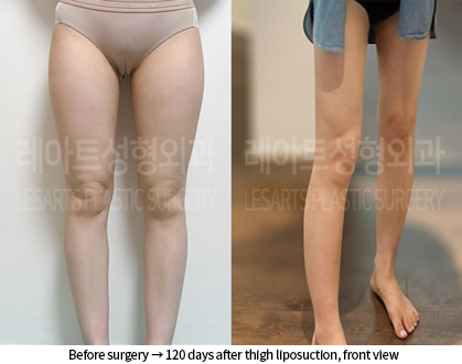thigh_liposuction_02_08_240909