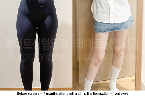 thigh_liposuction_02_08_240923