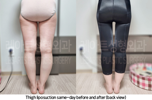 thigh_liposuction_02_08_240930