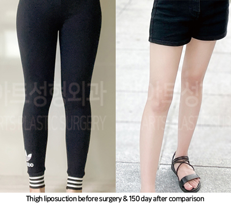 thigh_liposuction_02_08_241025