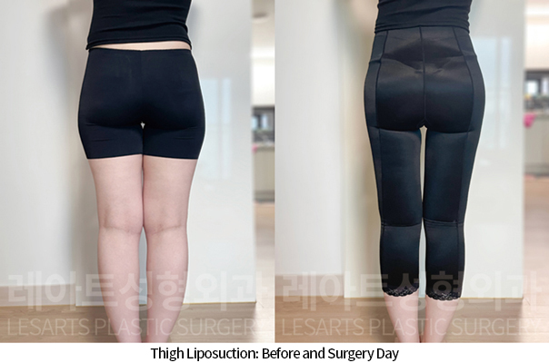 thigh_liposuction_02_08_241118