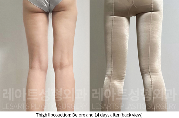 thigh_liposuction_02_08_241218