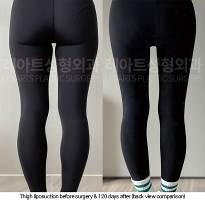 thigh_liposuction_02_08_250114