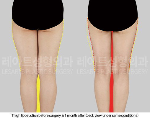 thigh_liposuction_02_08_250124