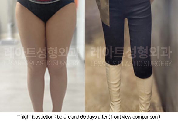 thigh_liposuction_02_08_250211