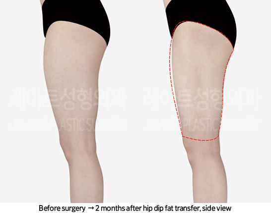 thigh_liposuction_02_09_240822
