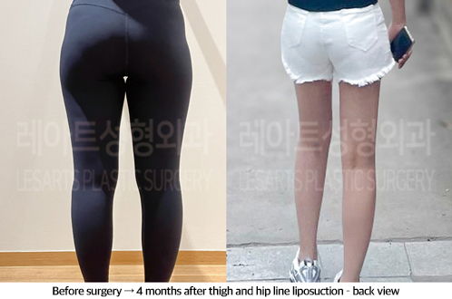 thigh_liposuction_02_09_240923