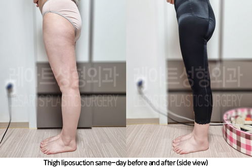 thigh_liposuction_02_09_240930