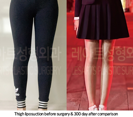 thigh_liposuction_02_09_241025
