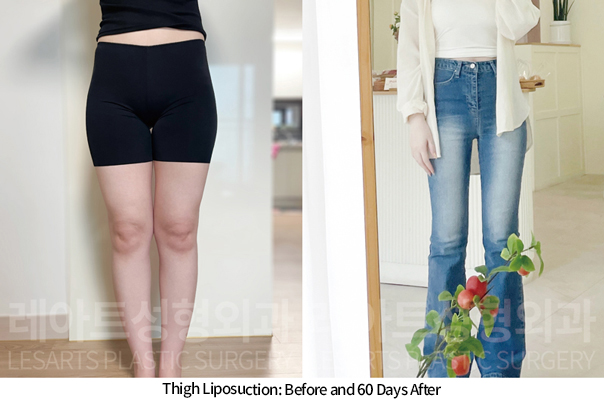 thigh_liposuction_02_09_241118
