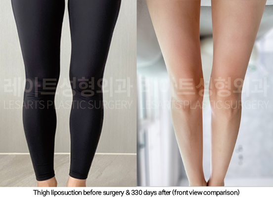 thigh_liposuction_02_09_250114