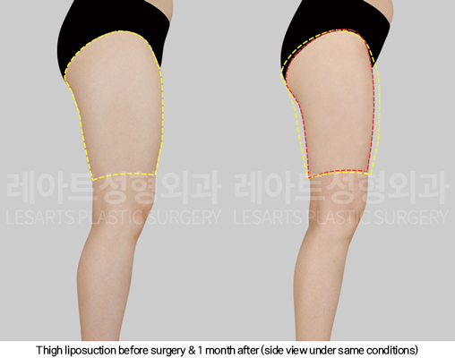 thigh_liposuction_02_09_250124