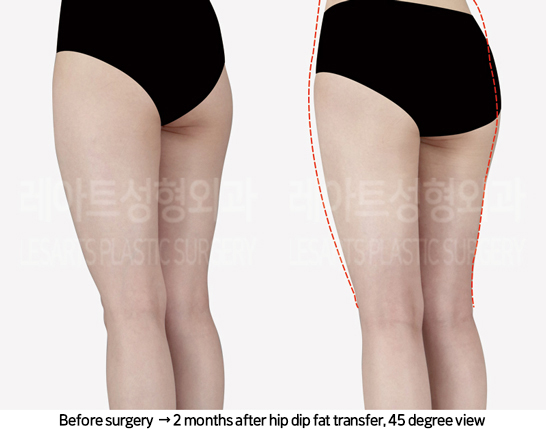 thigh_liposuction_02_10_240822