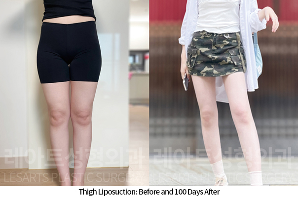 thigh_liposuction_02_10_241118