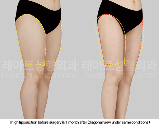 thigh_liposuction_02_10_250124