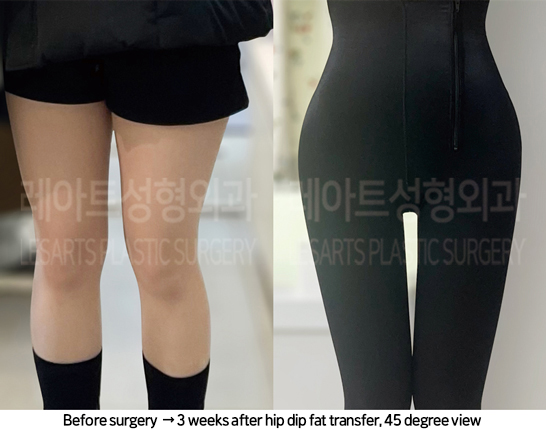 thigh_liposuction_02_11_240822