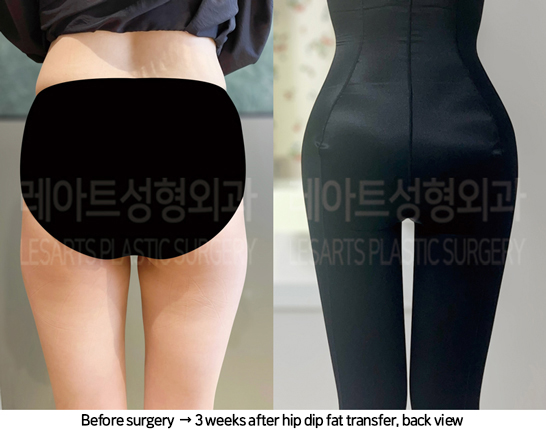 thigh_liposuction_02_12_240822