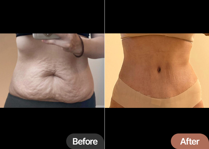tummy-tuck-thumbnail-Dongijeongi