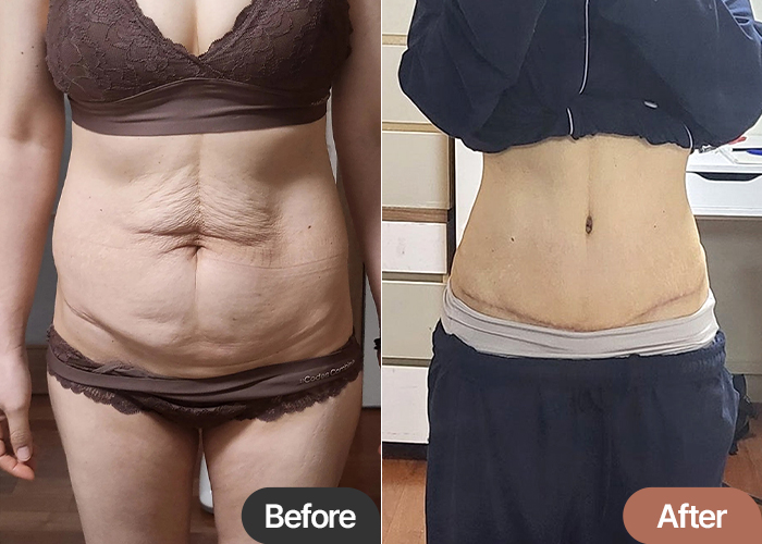Before and after tummy tuck and liposuction of Geuraeoneulun in Korea—dramatic change in skin tightness and waist shape.