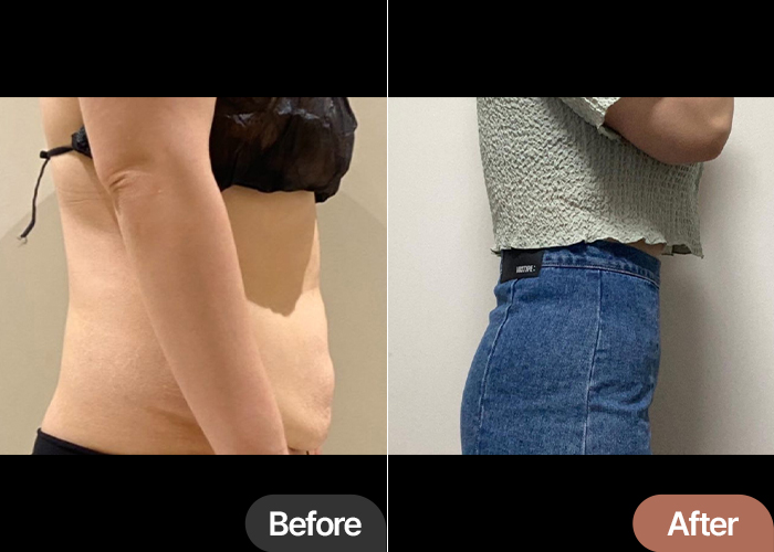 tummy-tuck-thumbnail-Gominhaegwan
