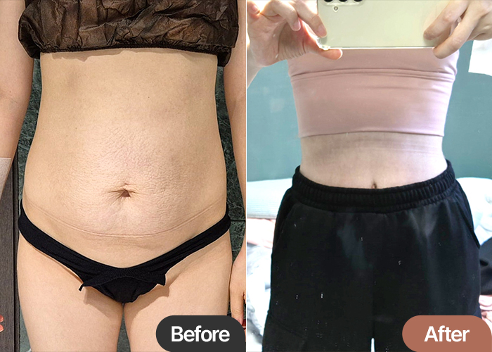 Before and after tummy tuck of Jingjingssi in Korea—major improvement in abdominal tightness and belly shape.