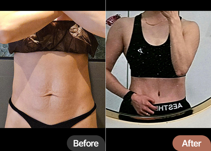 Before and after tummy tuck of UnniAoPoNX in Korea—dramatic transformation in skin tightness, belly contour, and posture.