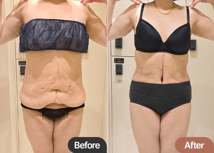 Before and after tummy tuck of Dasitaeeonayana in Korea—dramatic improvement in abdominal skin, posture, and clothing fit.