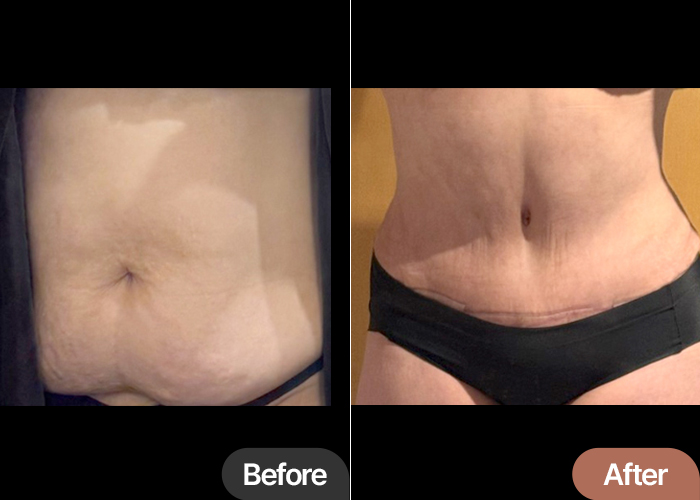 Before and after tummy tuck of Geumgunggeum in Korea—visible removal of excess belly skin and restored waist contour.