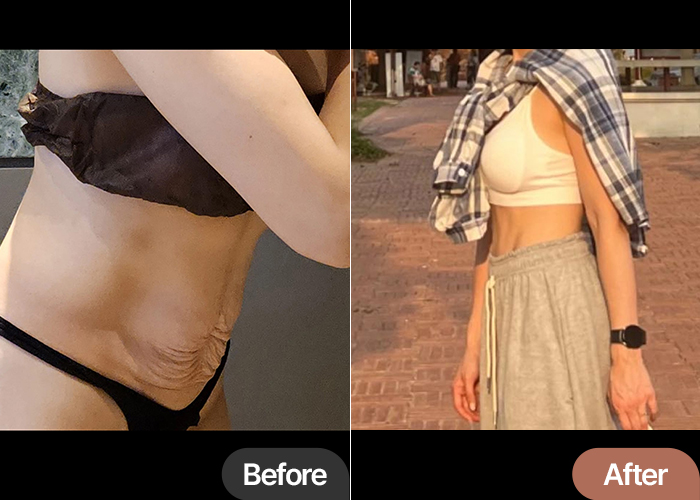 Before and after comparison of tummy tuck by Kukhan Lee at Lesarts in Korea, showing dramatic improvement in abdominal contour.