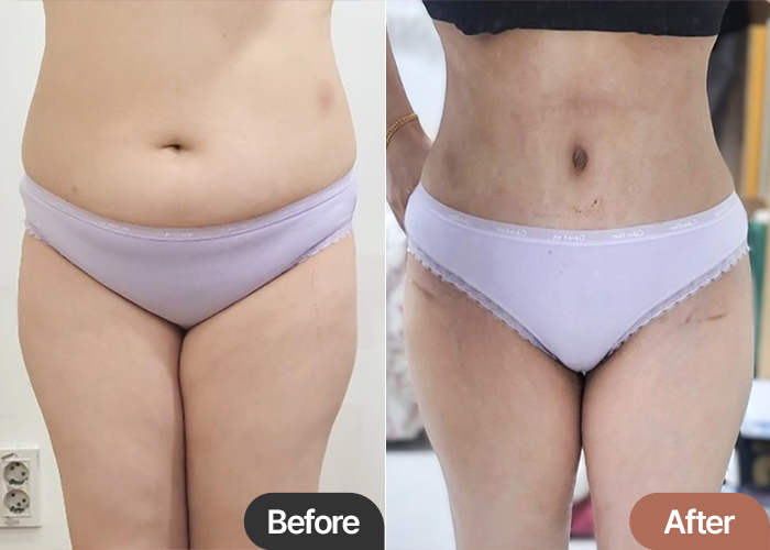 before and after photo comparison of tummy tuck and hip fat transfer - meongkomam at Lesarts