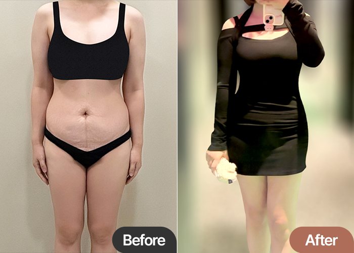 Before and after comparison of thdsk0810’s tummy tuck in Korea, clearly showing contour and stretch mark improvement.