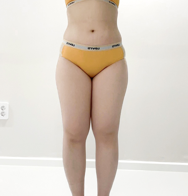 unniRY4fd2's abdominal liposuction and thigh liposuction before photo at Lesarts in Korea.