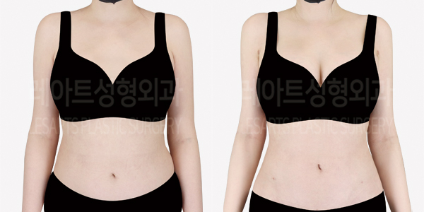 upper_body_liposuction_01_thumbnail_240814