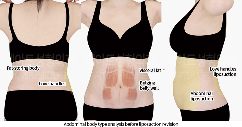 upper_body_liposuction_02_02_240814