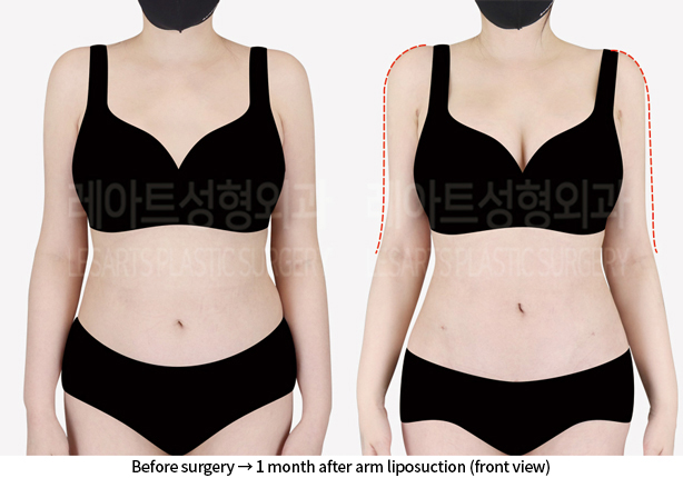 upper_body_liposuction_02_03_240814