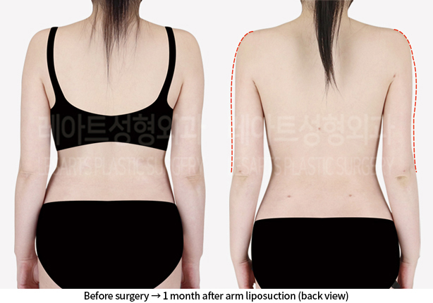 upper_body_liposuction_02_04_240814