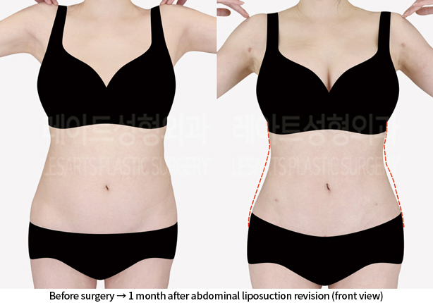 upper_body_liposuction_02_06_240814