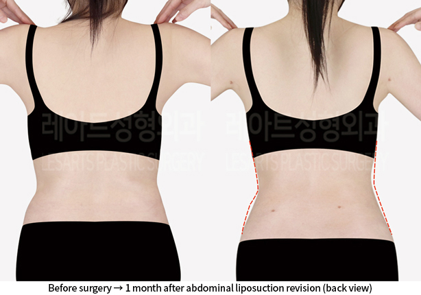 upper_body_liposuction_02_07_240814