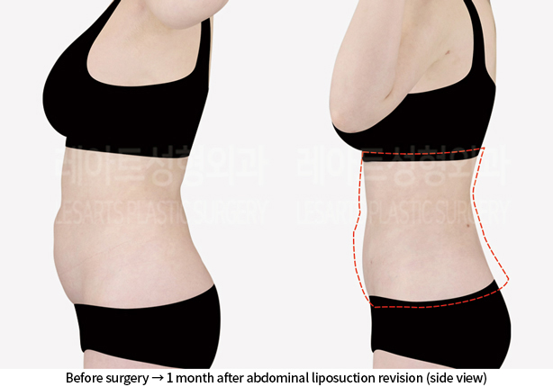 upper_body_liposuction_02_08_240814