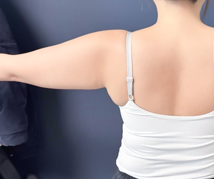 Bulky upper arms before liposuction surgery – Lesarts Korea