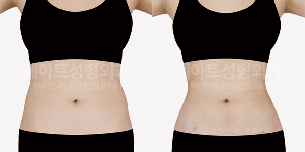abdominal_liposuction_01_thumbnail_250221