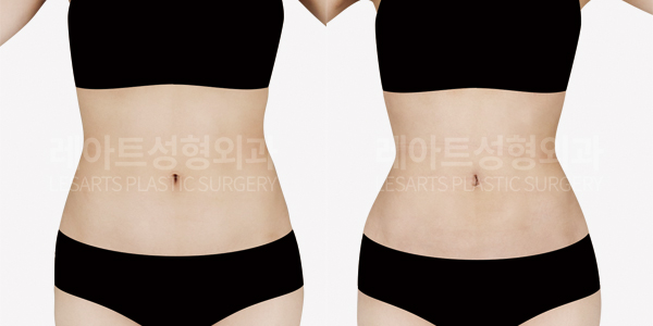 abdominal_liposuction_01_thumbnail_250313