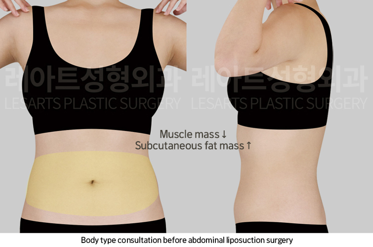 abdominal_liposuction_02_01_250221