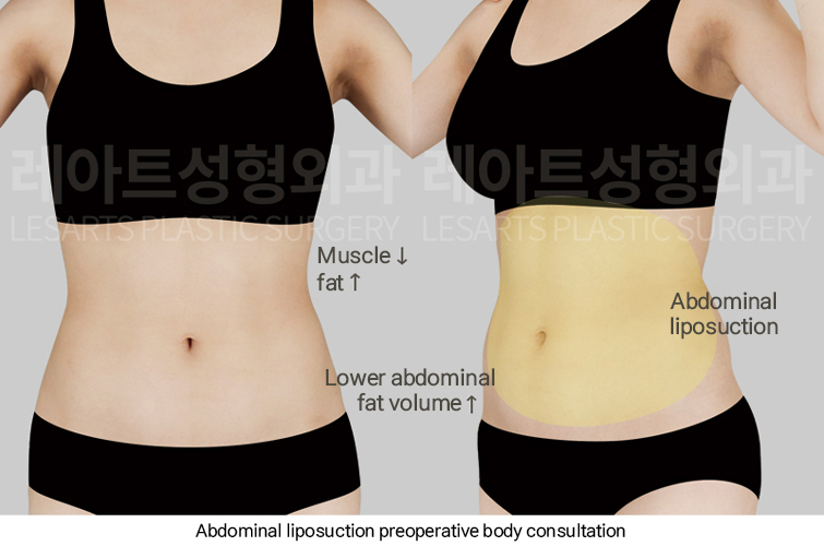 abdominal_liposuction_02_01_250313