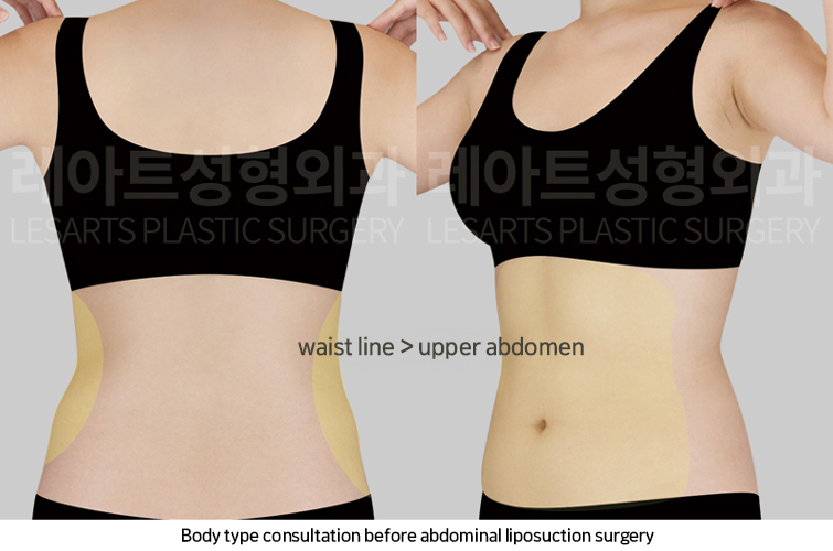abdominal_liposuction_02_02_250221